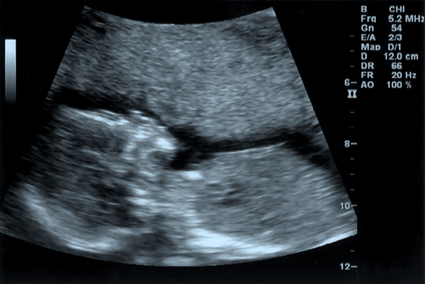 Sixteen Week Ultrasound Scan