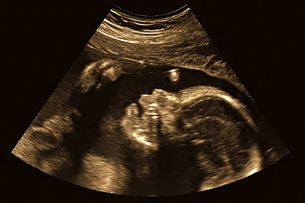 Baby in Ultrasound Image